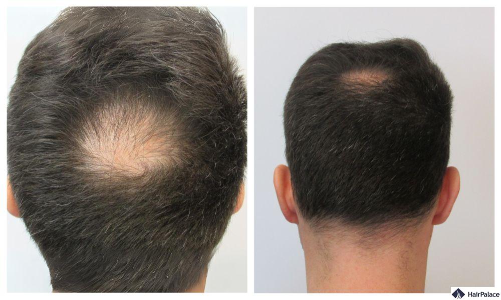 norwood scale 3 vertex